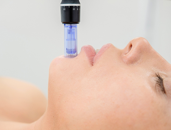 Woman having Microneedling Treatment in Longmont, CO