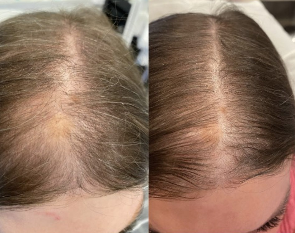 Hydrafacial keravive scalp treatment before and after