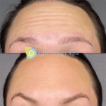 Xeomin Treatment Before and After at Sunflower Spa