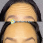 Xeomin Before and After at Sunflower Spa
