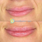 Lip Filler Before and After at Sunflower Spa