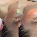 Dermaplaning Before and After at Sunflower Spa