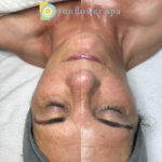 You glow girl! This side-by-side comparison demonstrates the afterglow from a Hydrafacial