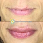 Lip Filler