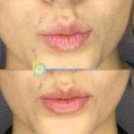 Xeomin & Lip Flip