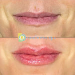Sunflower-Spa-Lip-filler-2